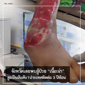 จังหวัดเลย พบผู้ป่วยโรคเนื้อเน่า สูงสุดในประเทศ 3 ปีซ้อน